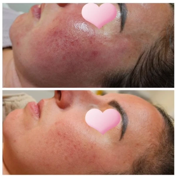 biopeeling resultaat